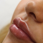 Пациентка Яны Кизюн после липофилинга губ