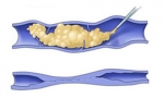 Введение склерозанта в пораженную вену