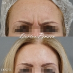 Пациентка доктора А.А. Пенаева до и после процедуры «Вечный Ботокс»