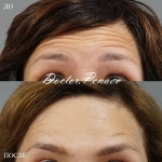 Пациентка доктора А.А. Пенаева до и после процедуры «Вечный Ботокс»